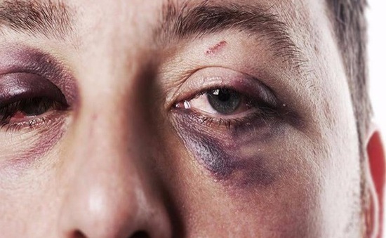 Vỡ xương hốc mắt - Hình ảnh minh họa